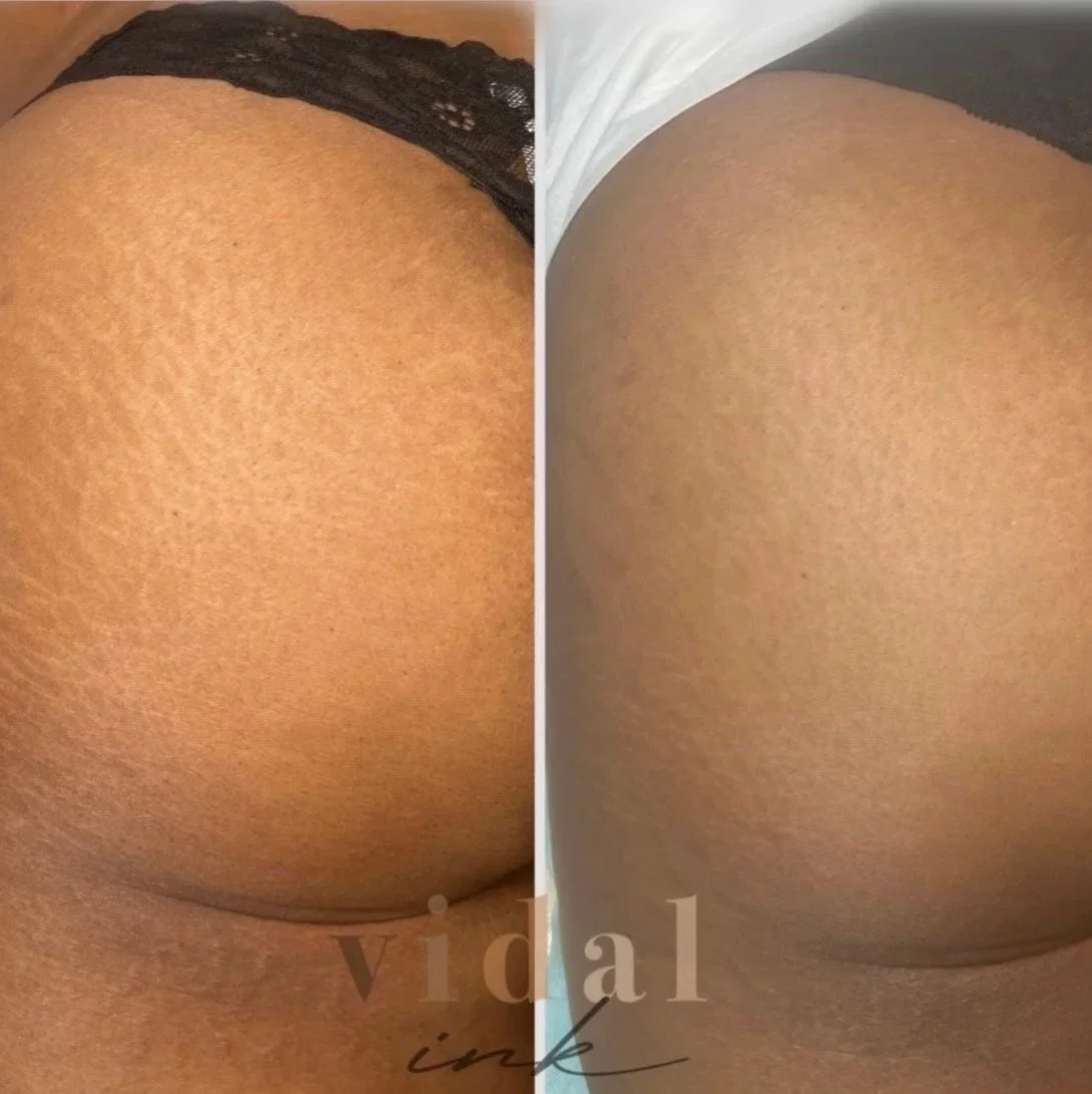 Close-up of a person's buttocks shown from the side, with dark marks, before and after skin treatment of skin camouflage