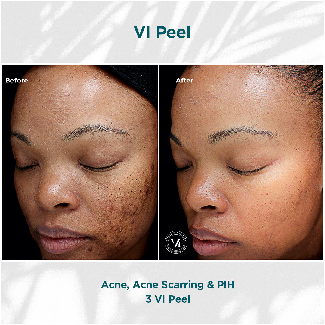 Rejuvenate the Skin You're In With a Chemical Peel - Dontage