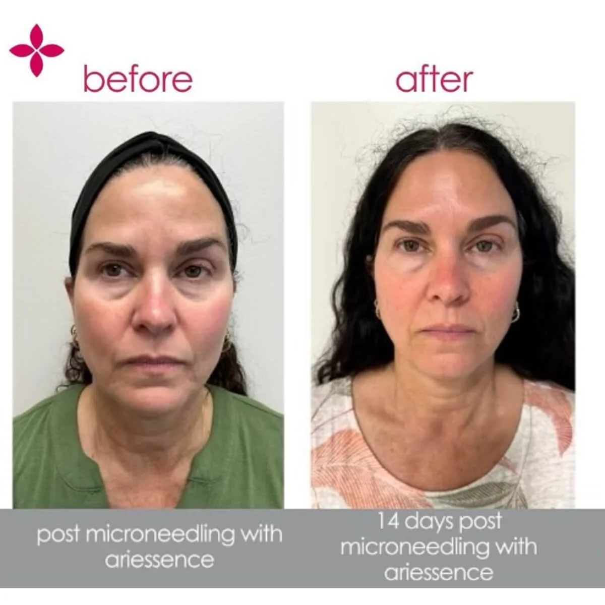 Ariessence PDGF+ — About Faces Cosmetic Surgery and Med Spa