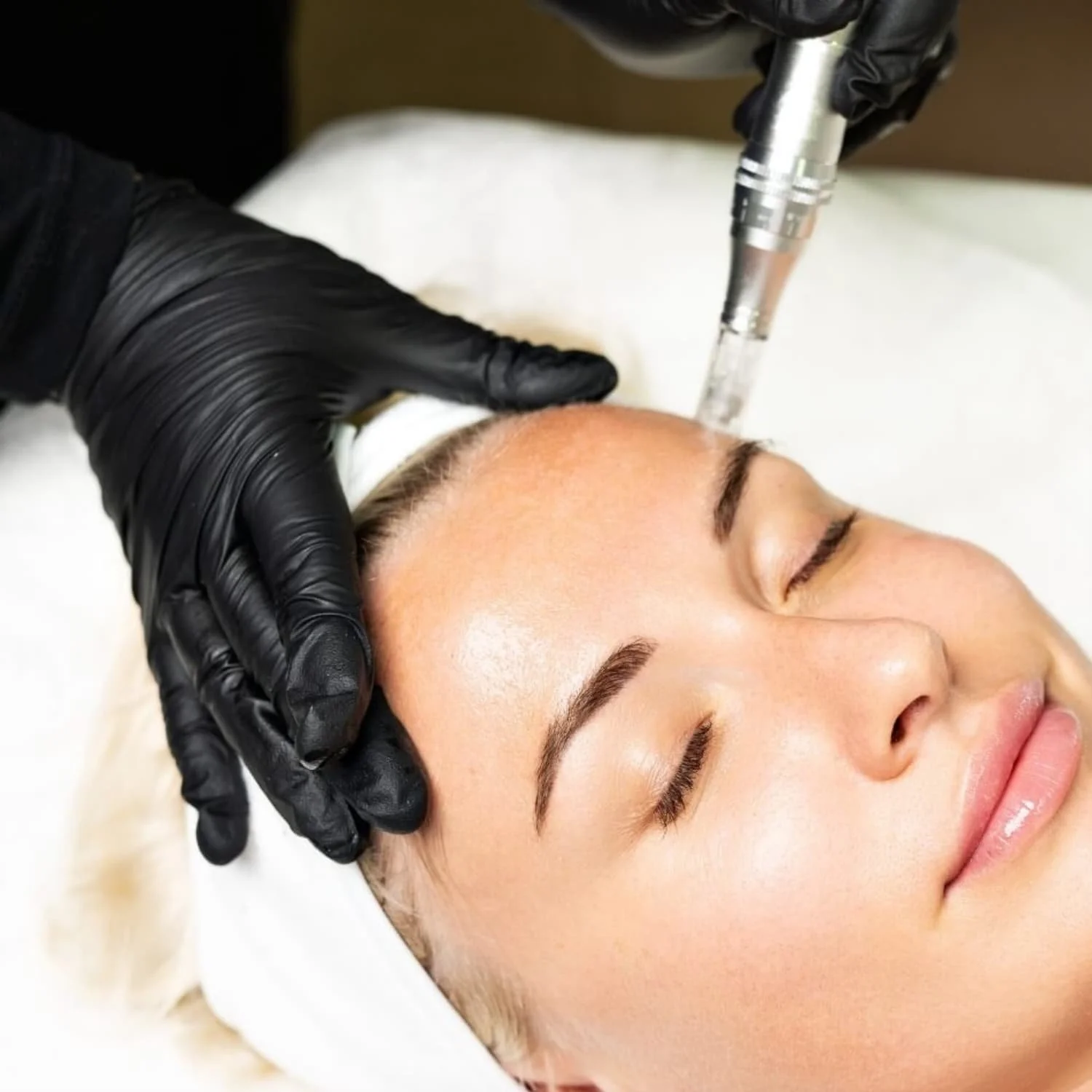 Woman getting microneedling