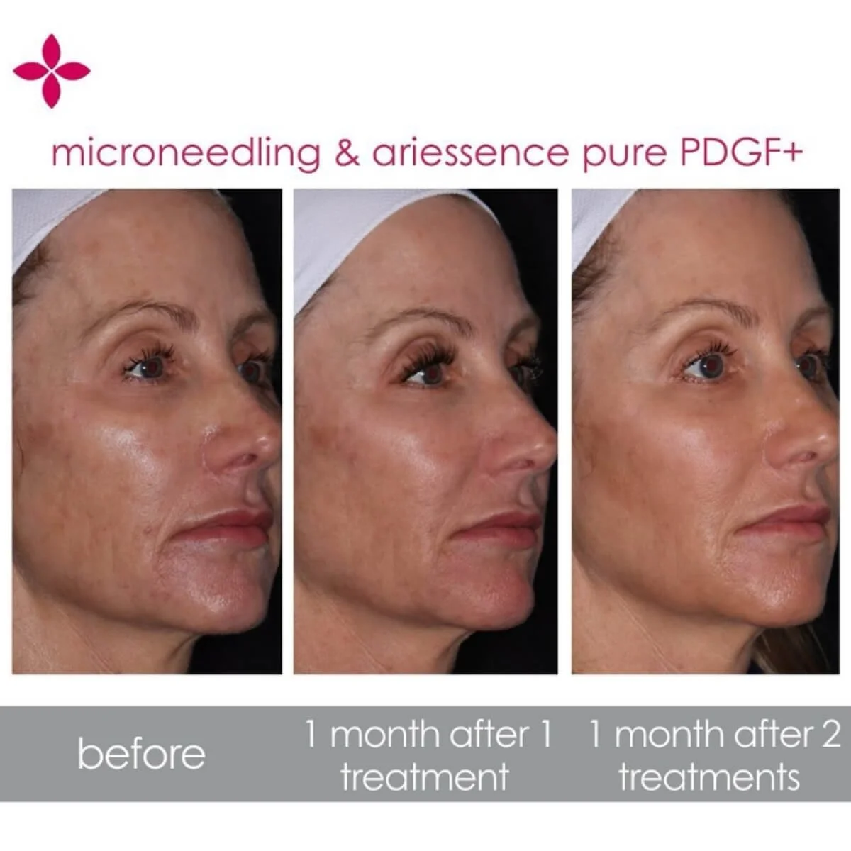 Ariessence PDGF+ — About Faces Cosmetic Surgery and Med Spa