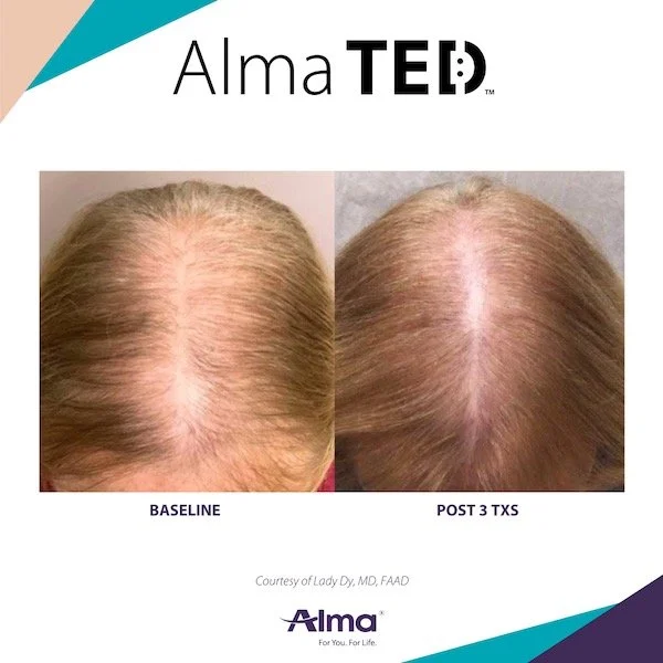 Alma TED Hair Restoration | Restore Hair Today - Schedule a ...