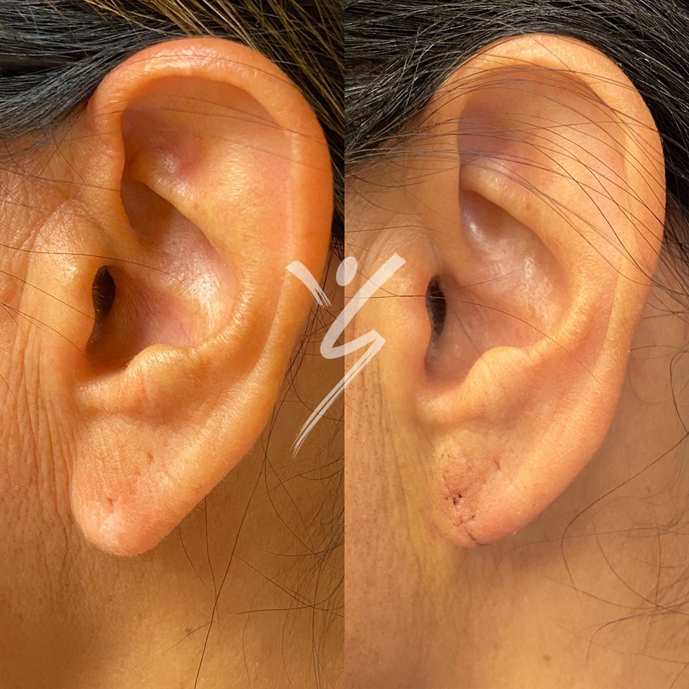 Earlobe Repair: Restore Your Ears with Dr. Lopes - Cosmetic Surgery Center