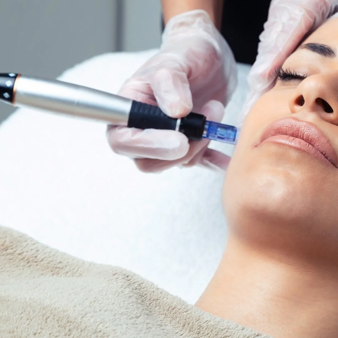 Woman getting microneedling treatment