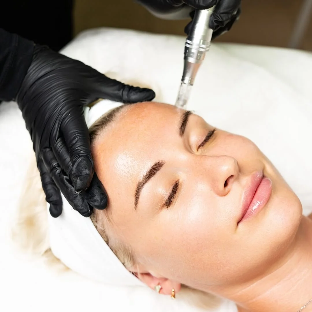 Microneedling Treatment done on face