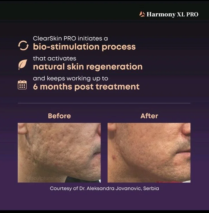 ALMA ClearSkinPRO acne scarring on an adult male showing before and after results from treatment.