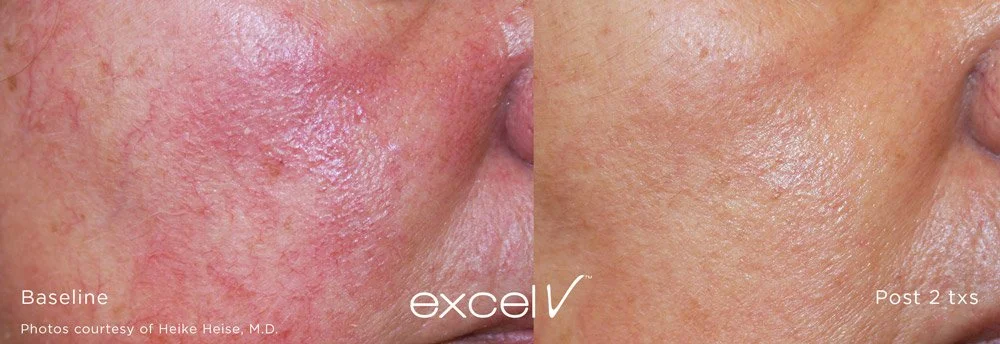 Before and after results for Rosecea treatment of woman's face using Cutera Excel V+ Laser