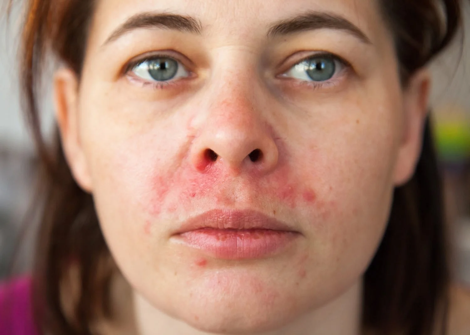 Woman suffering from Perioral Dermatitis, seen as a red facial rash around her nose and mouth.