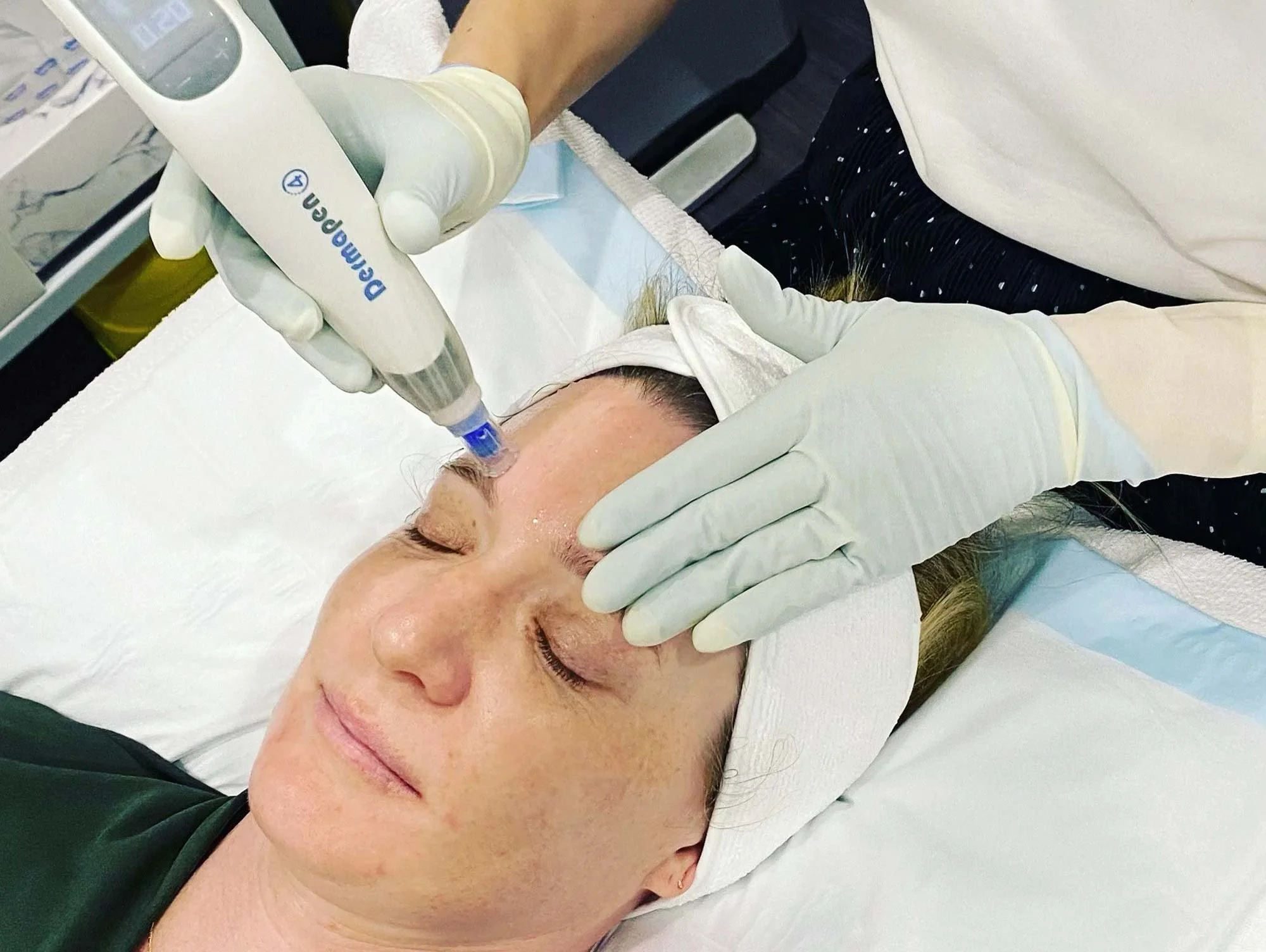 Woman receiving Dermapen microneedling treatment on her face in the Gold Coast Dermatology Clinic