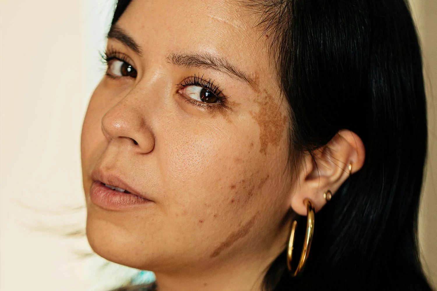 Brunette woman with a large birthmark on the side of her face.