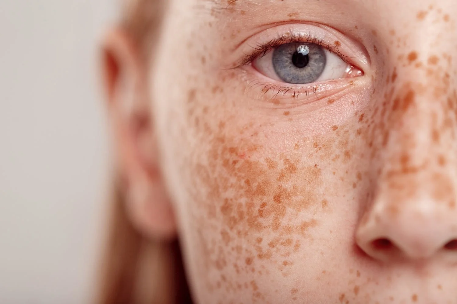 Close-up of women’s face with blue eyes and excessive pigmentation on her face in the form of freckles.