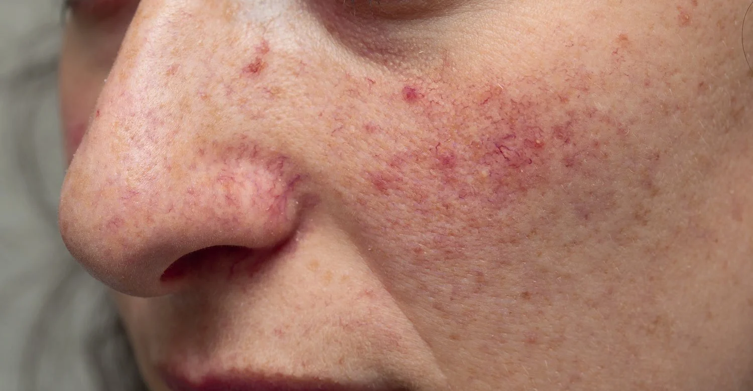Close-up of women's face with redness on cheeks and around nose.