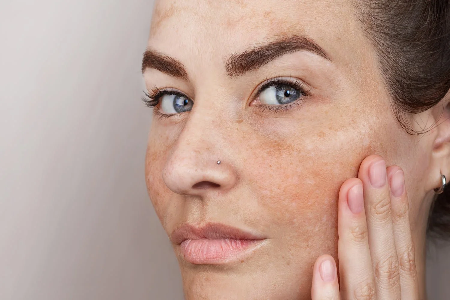 Woman with Melasma on her cheek is touching her face with her hand.