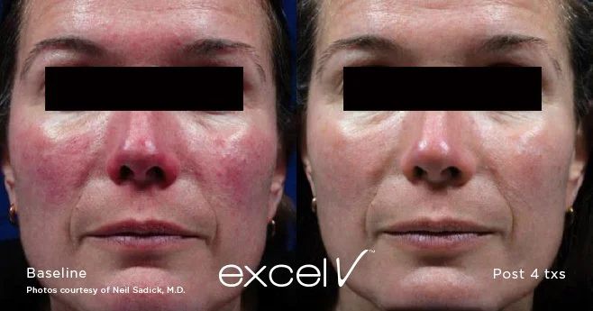 Before and after results for Rosecea treatment of woman's face using Cutera Excel V+ Laser