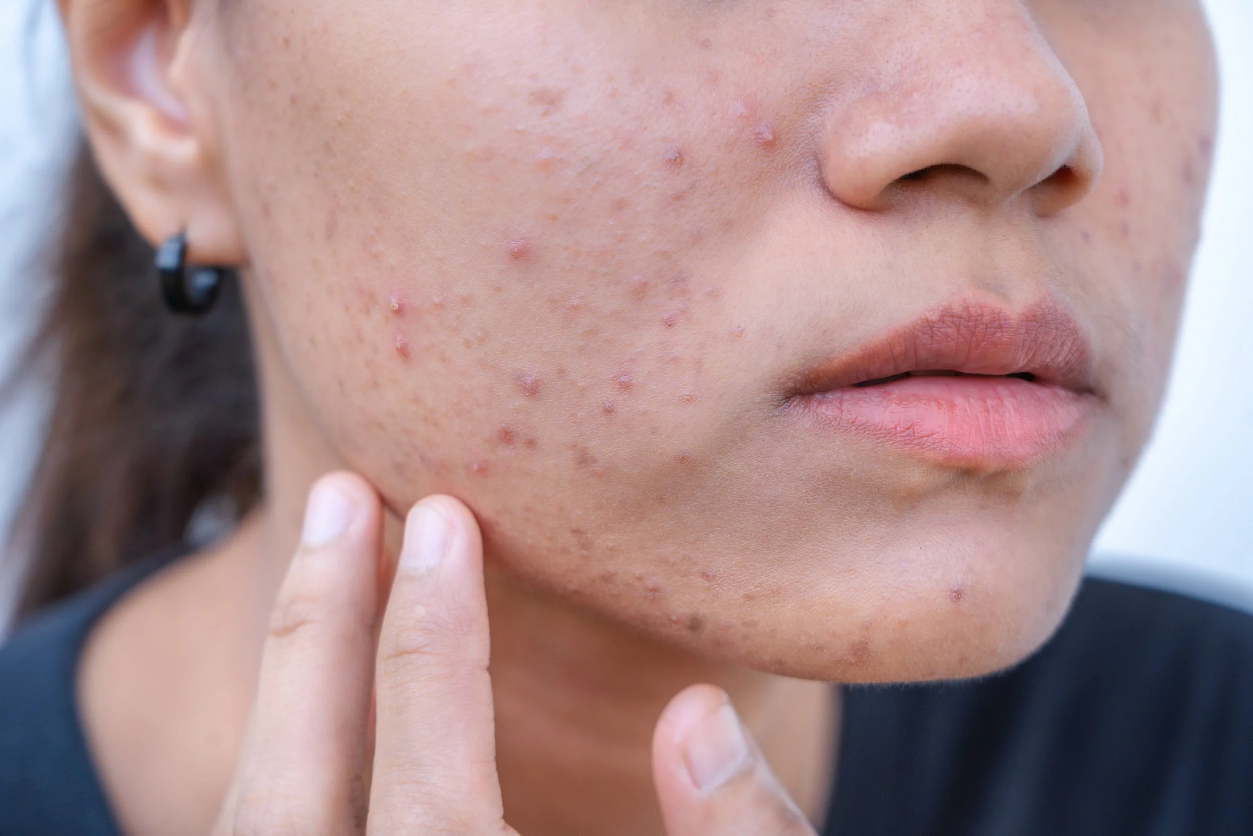 inflammatory acne
