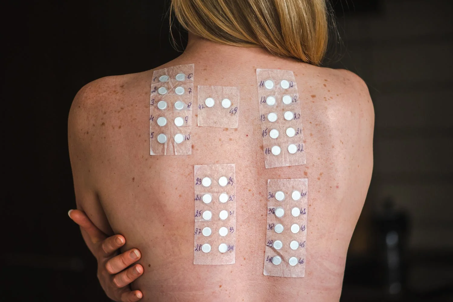 Woman’s back showing allergy patch testing