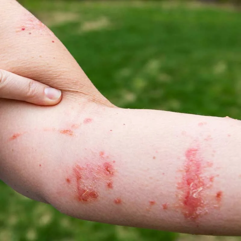 Poison Oak Rash Vs Poison Ivy Recognizing Poison Ivy Oak And Sumac