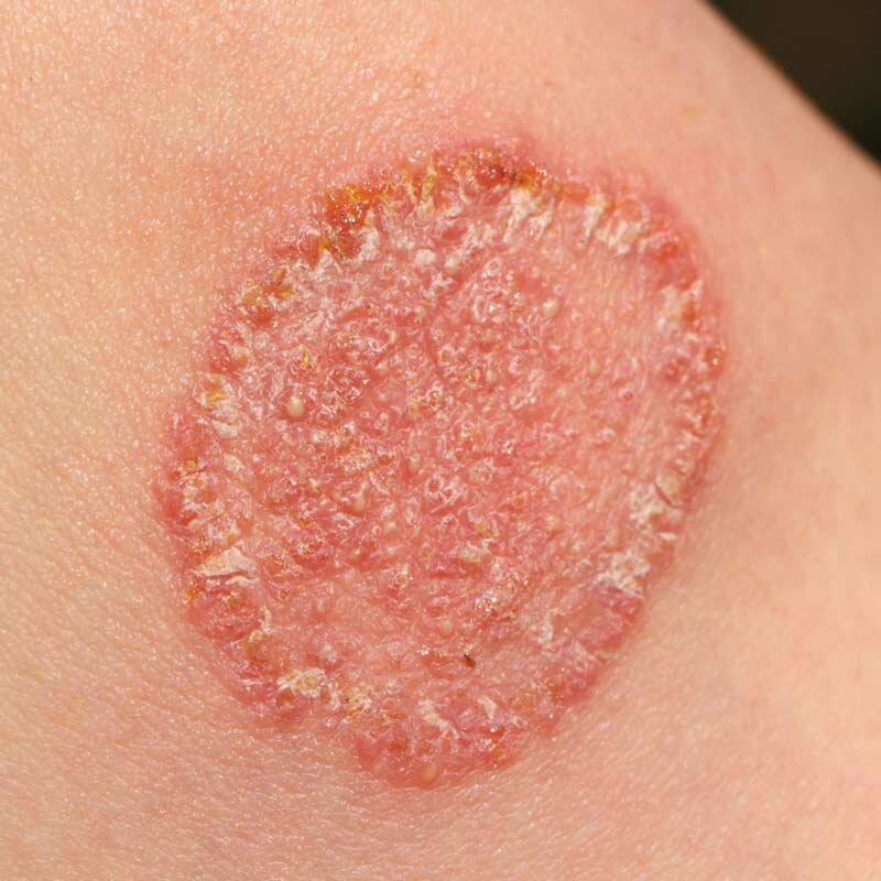 Fungal Infections — Fora Dermatology General And Surgical Dermatology