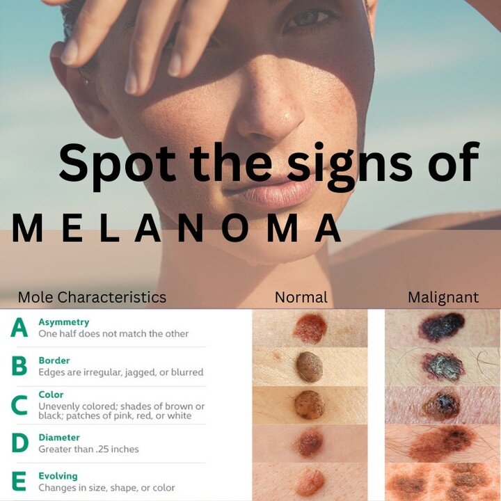 It's #MelanomaMonday and at Fora Dermatology, we are committed to raising awareness about skin cancer prevention and early detection. Make sure you shield your skin from harmful UV rays by wearing sunscreen, hats, and protective clothing. Always reme