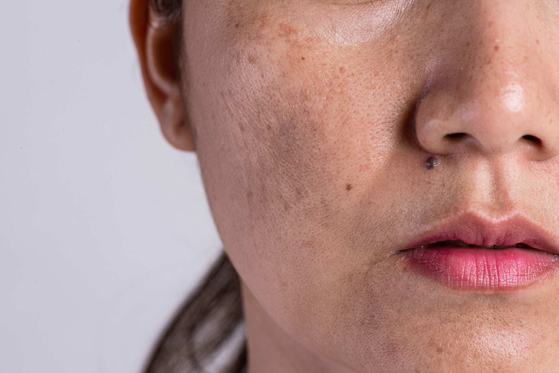 Brown Spots and Freckles  Faciem Dermatology Clinic
