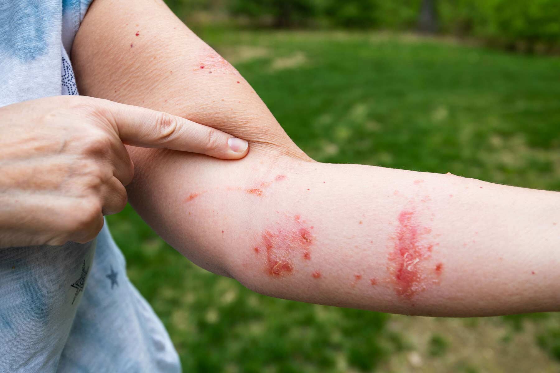 Poison Sumac Rash On Hands