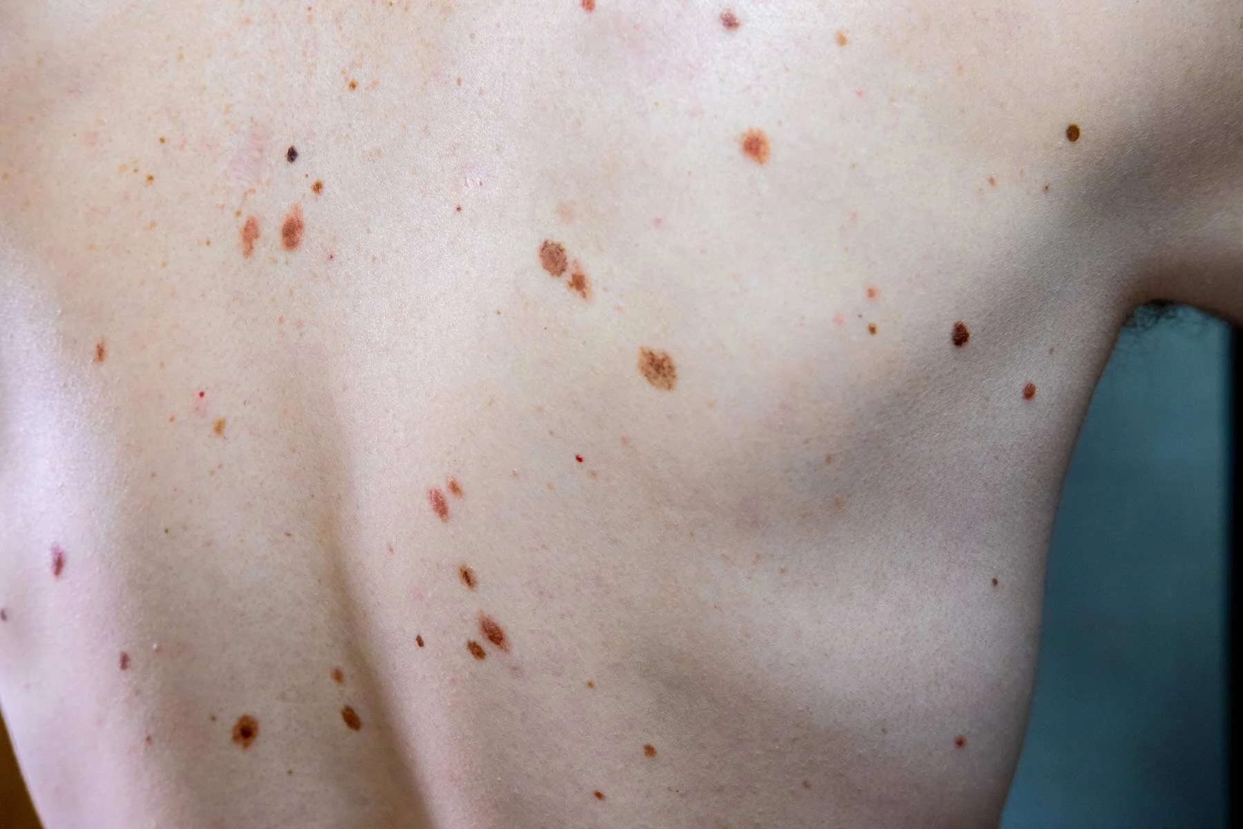 atypical-nevi-dysplastic-nevi-pc-dermatology-general-surgical