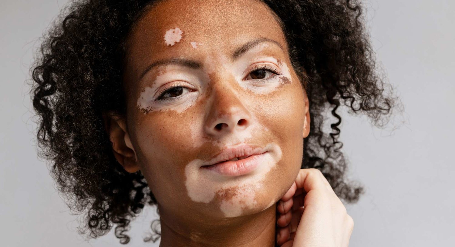 vitiligo-fora-dermatology-general-surgical-dermatology-in