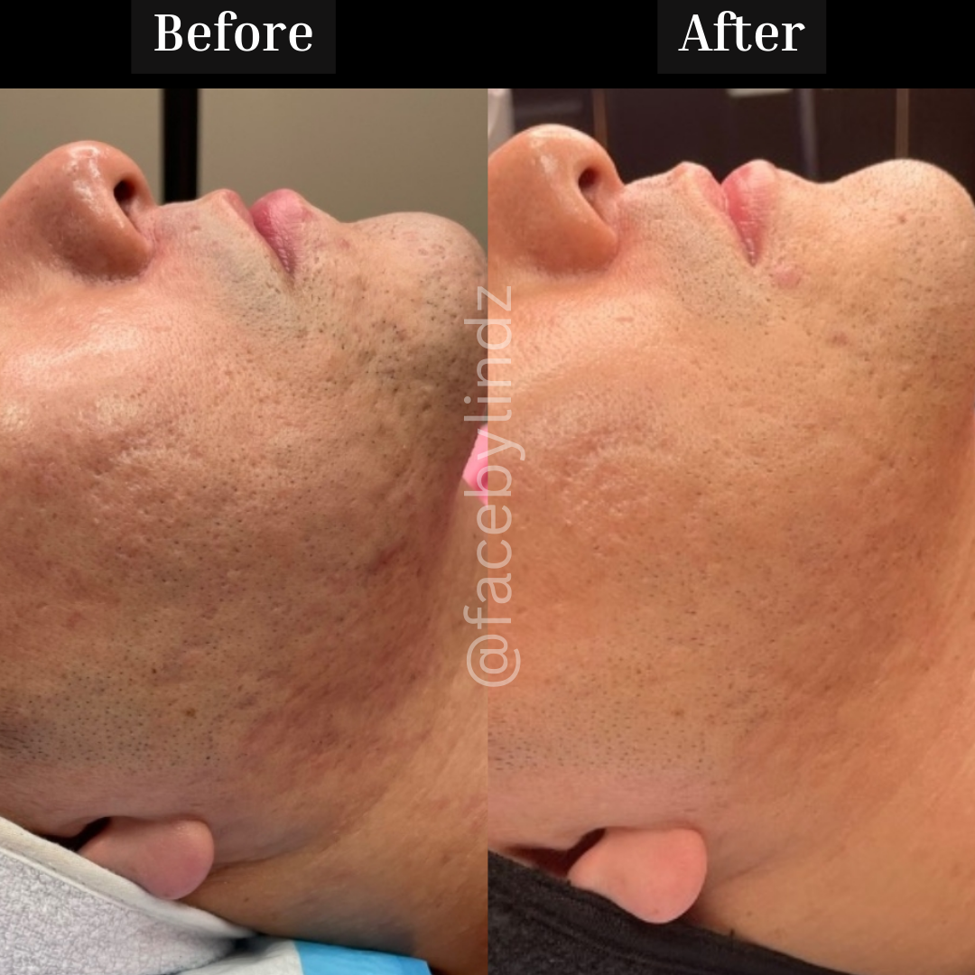 Copy of Before after minimal skincare Instagram post - 5.png