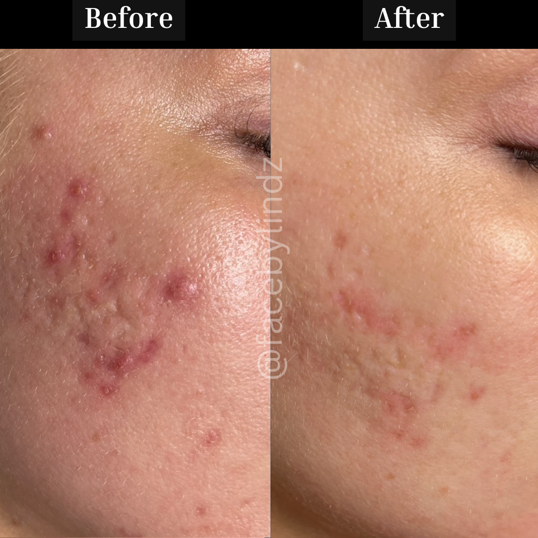 Copy of Before after minimal skincare Instagram post - 4.png
