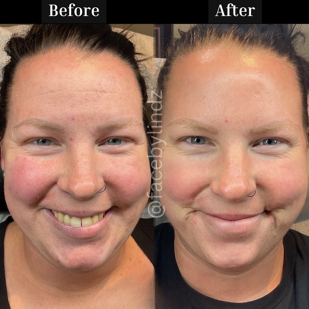 Copy of Before after minimal skincare Instagram post - 1.png