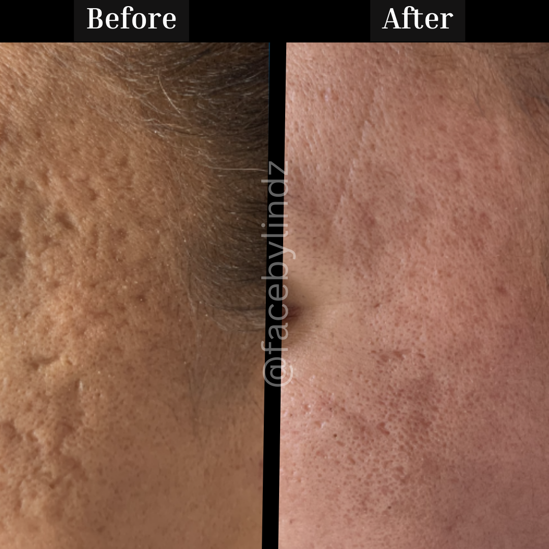 Copy of Before after minimal skincare Instagram post - 3.png