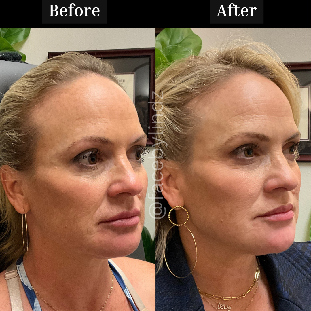 Copy of Before after minimal skincare Instagram post - 6.png