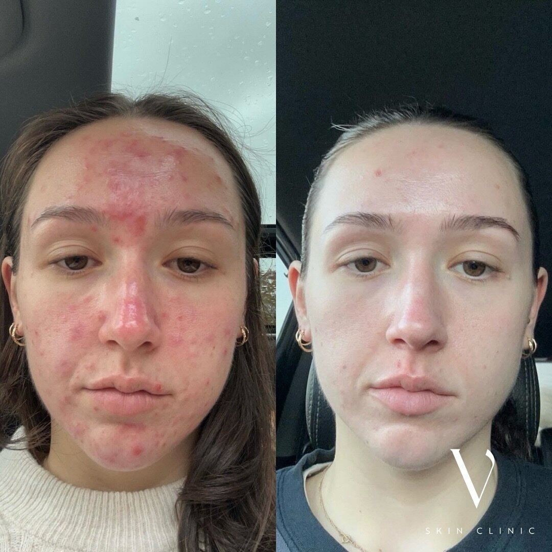 Haters will say it was Accutane lol but really 👇🏼

No antibiotics, no medications, no topical prescriptions.
Just a curated skincare routine and my custom acne treatments 💁🏼&zwj;♀️ 

Ready to take the leap and tackle your acne that&rsquo;s been h