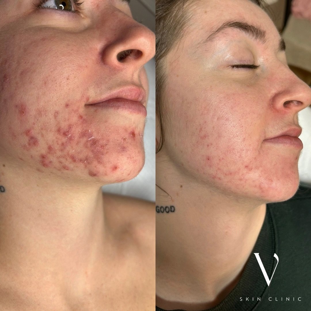 Another day, another slay 🧚&zwj;♂️

Proud to be Ottawa&rsquo;s 1 and only paramedical acne specialist 💁🏼&zwj;♀️ here to help you clear your stubborn acne when doctors told you accutane was your only option&hellip; 

Get in contact 👇🏼

📲613-298-