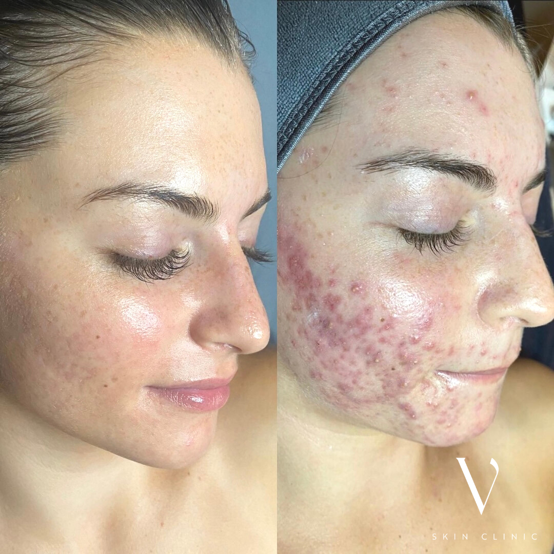 Before & After Pictures of Clients - Vanity Cosmetic Clinic