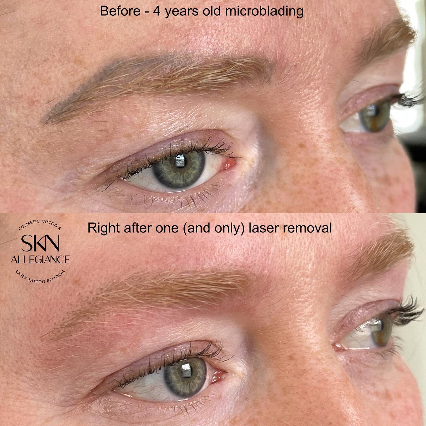 Just making women happy with their appearance again!🥹💔
@sknallegiance
Eyebrow permanent makeup is in fact a cosmetic TATTOO! It is not SEMI-permanent how dishonest pmu artists try to deceive you!
Want to get rid of your face tattoo and don&rsquo;t 