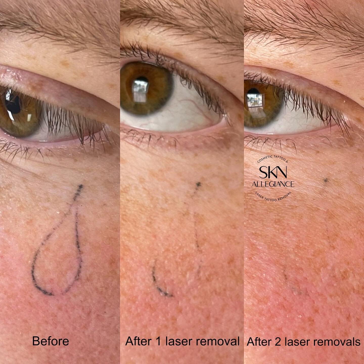 Wipe away your tears! No more suffering from looking at a tattoo you no longer like🥲
Laser removal makes it possible to get rid of ink and do so safely for your skin!😉
⠀
*Every tattoo (and client) is unique and will have a different fading progress