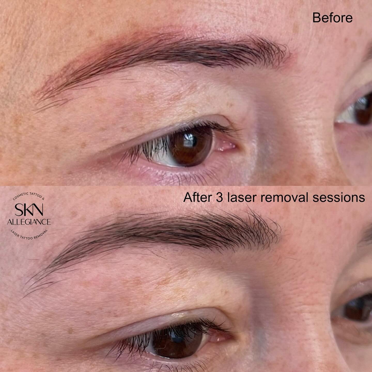 Removal of red pigment from eyebrows‼️
⠀
Yes, of course not all red pigment is the same. But it shouldn&rsquo;t be a worry of a client, but rather something that a removal specialist should be educated on and experienced in how to distinguish one pig