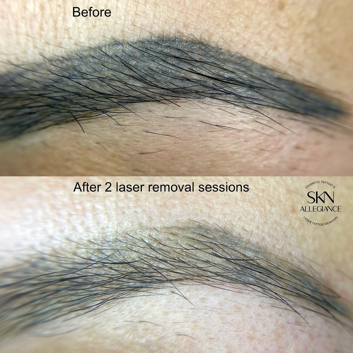 MICROBLADING REMOVAL😤
⠀
Many reasons why I hate microblading, but more than anything I hate removing it.
⠀
Cause that cosmetic tattoo technique besides scarring the skin, messing up skin structure and texture - also implants the ink super unevenly. 