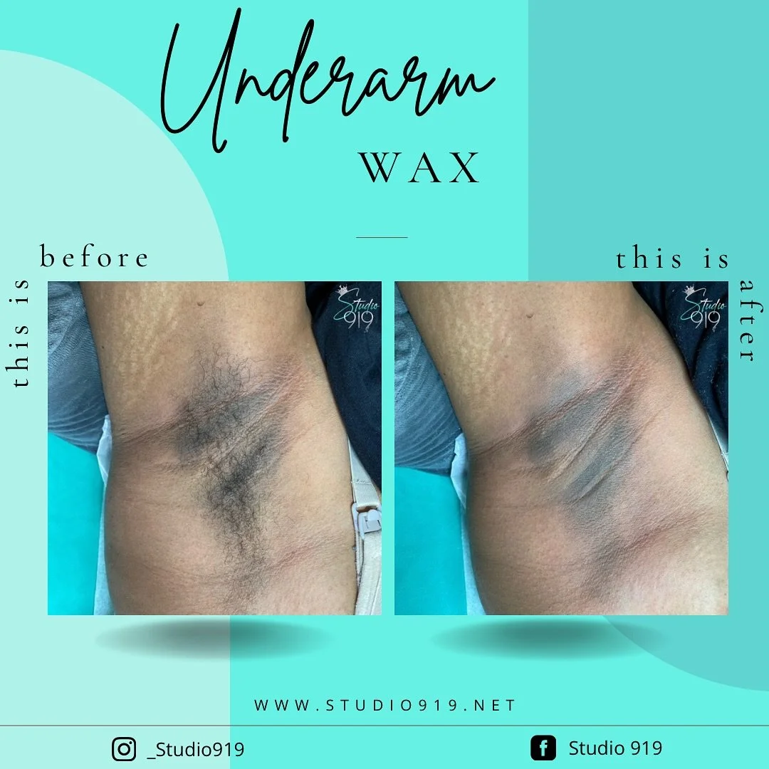 After Years of Shaving, She Finally Decided to Try Underarm Waxing!

Shaving Causes Razor Burn As Well As Hyperpigmentation, But with Adding Exfoliating to Her Regimen &amp; Staying Consistent with Waxing, Her Skin Will Heal &amp; Begin to Lighten ✨
