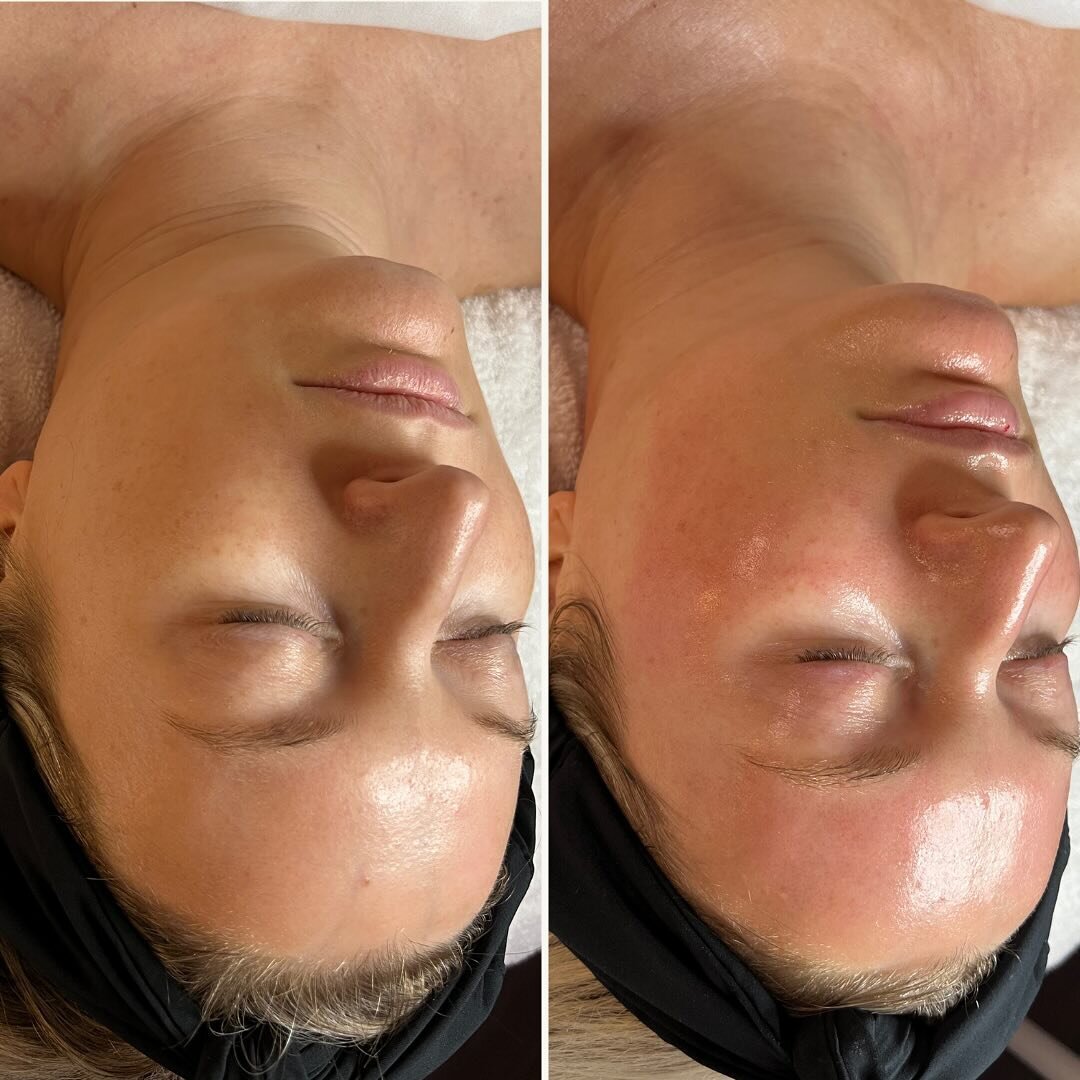A HydraFacial is one of the most powerful, non-invasive skin resurfacing treatments available today. It combines cleansing, exfoliation, extraction, hydration and antioxidant protection that removes dead skin cells and impurities, while simultaneousl