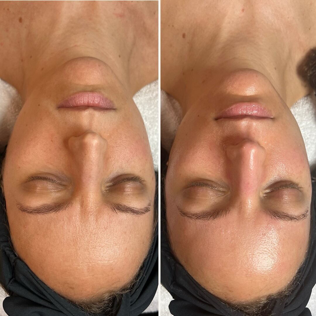 Take a look at the difference in the texture and pore size in this beauties skin after one HydraFacial! 👏🏼😍

🔗Link in bio to reserve a spot
📲text 309.573.1406 

&bull;
&bull;
&bull;

#Hydrafacial #Facial #healthyskin #selfcare #clearskin #medica