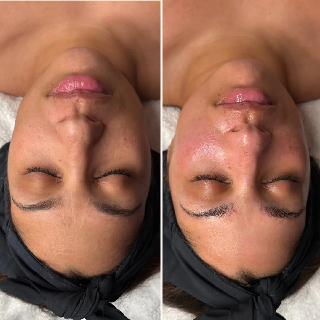 Platinum HydraFacial paired with Dermaplaning for smoother texture, brighter skin, and that glass-skin finish 💎

#birthdayselfcare #hydrafacial #dermaplaning #glowingskin #spaday #treatyourself #skincareroutine #facial