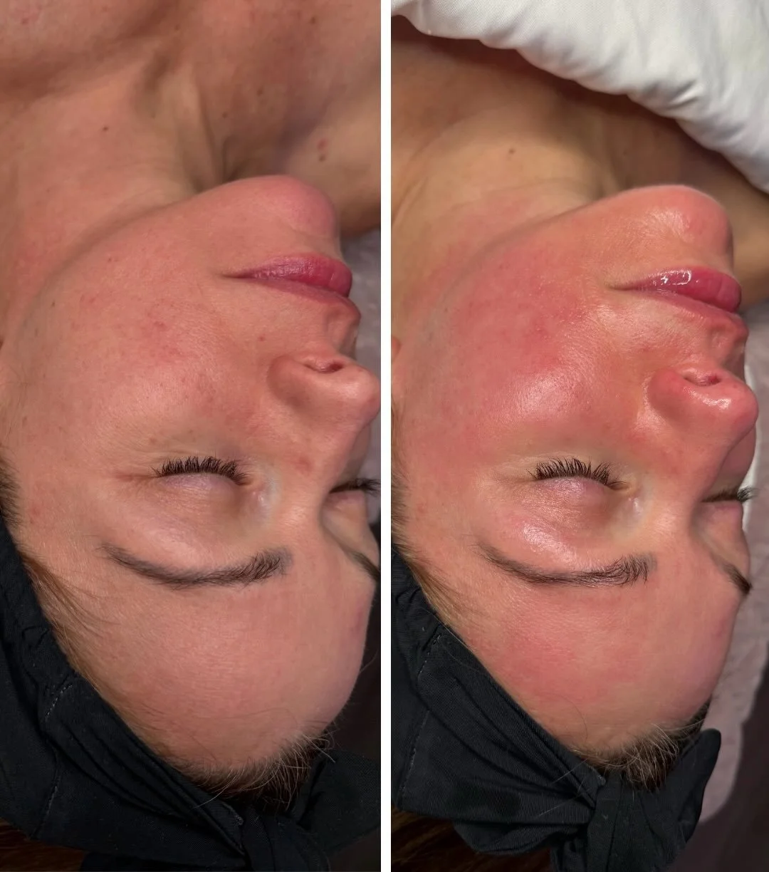 Before ➡️ After&hellip; obsessed 😍 

Deep cleanse. Serious glow. 💧✨

#hydrafacial #hydrafacialglow #hydratedskin #bestfacialintown