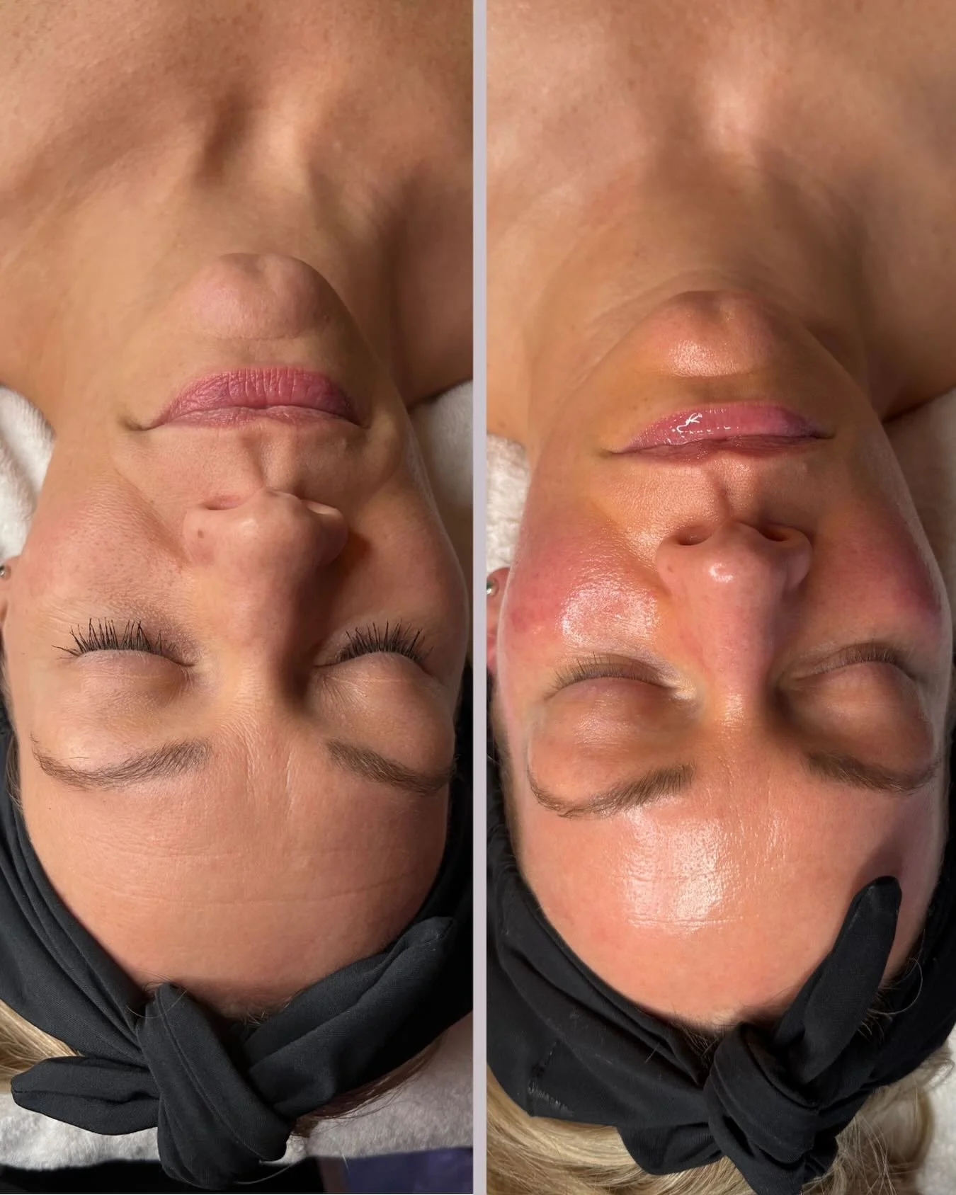 3 treatments&hellip; and your skin is already rebuilding itself from within. ✨ 
 
✨ What D&bull;E&bull;J BioStim actually is

D&bull;E&bull;J BioStim Treatment is a professional, no-needle biostimulator, meaning it stimulates your skin to rebuild its