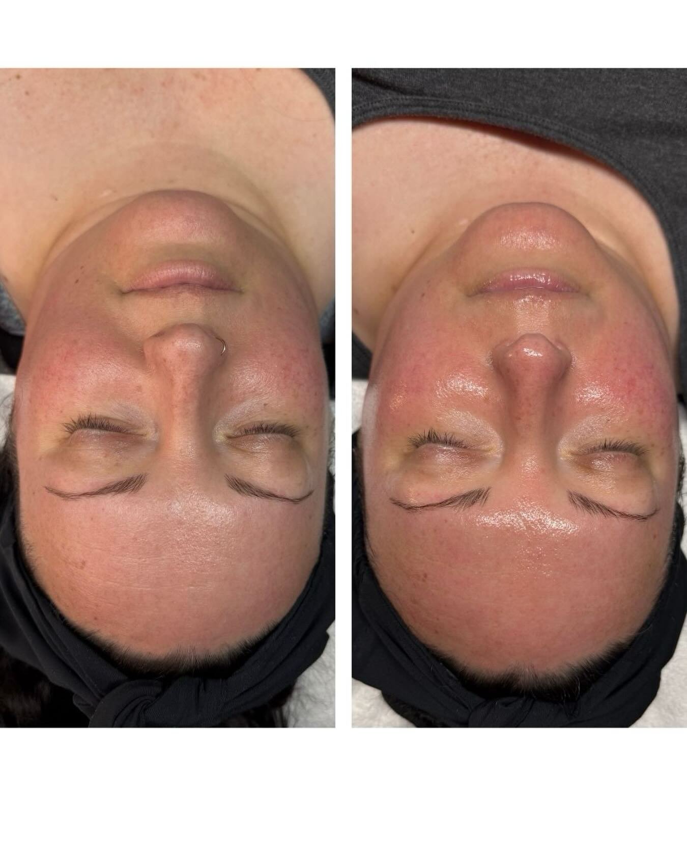 3 treatments&hellip; and your skin is already rebuilding itself from within. ✨

With a series of D&bull;E&bull;J BioStim treatments, you&rsquo;re not just seeing a surface glow, you&rsquo;re stimulating real collagen + elastin production where it mat