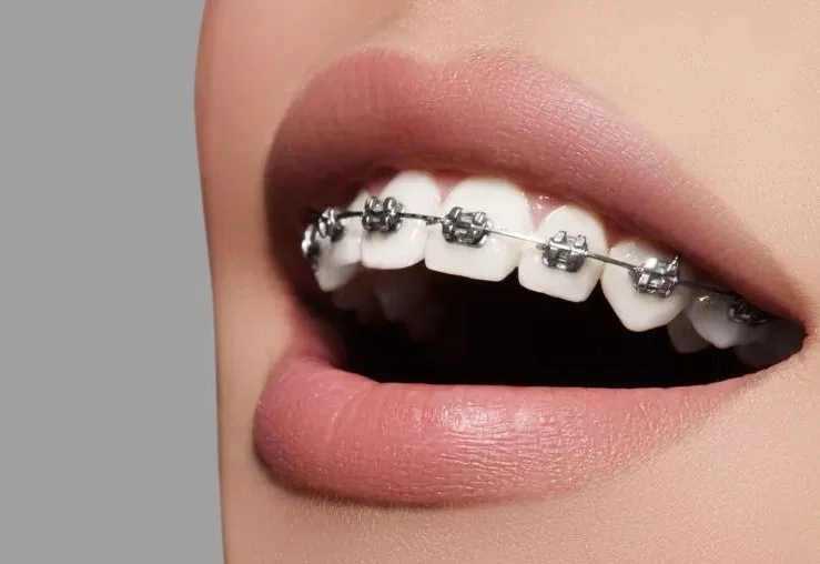 Orthodontic Treatment Process — Dentist Auckland NZ
