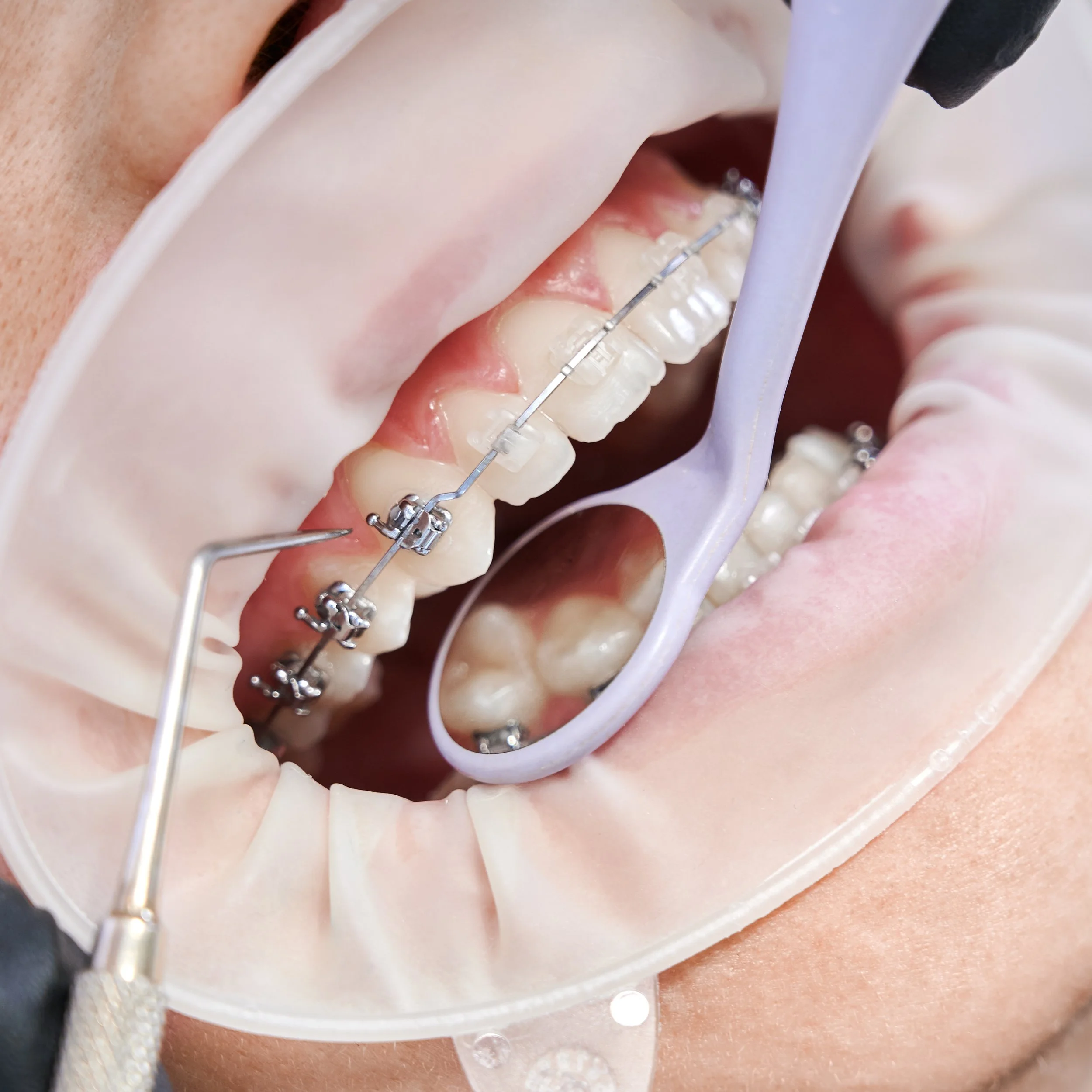 Braces Cost NZ — Dentist Auckland NZ