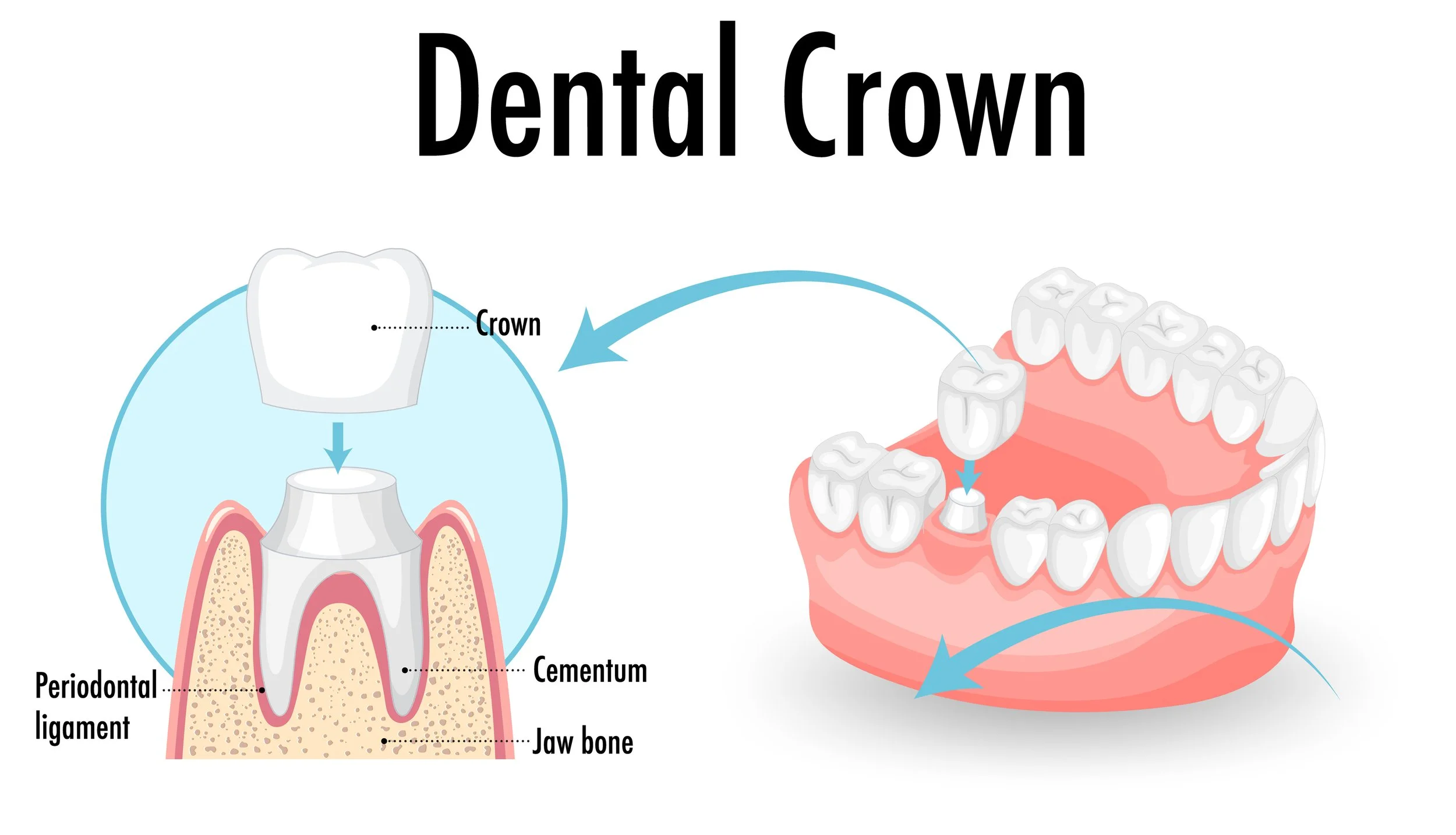 Tooth Crown Cost NZ Affordable Solutions — Dentist Auckland NZ