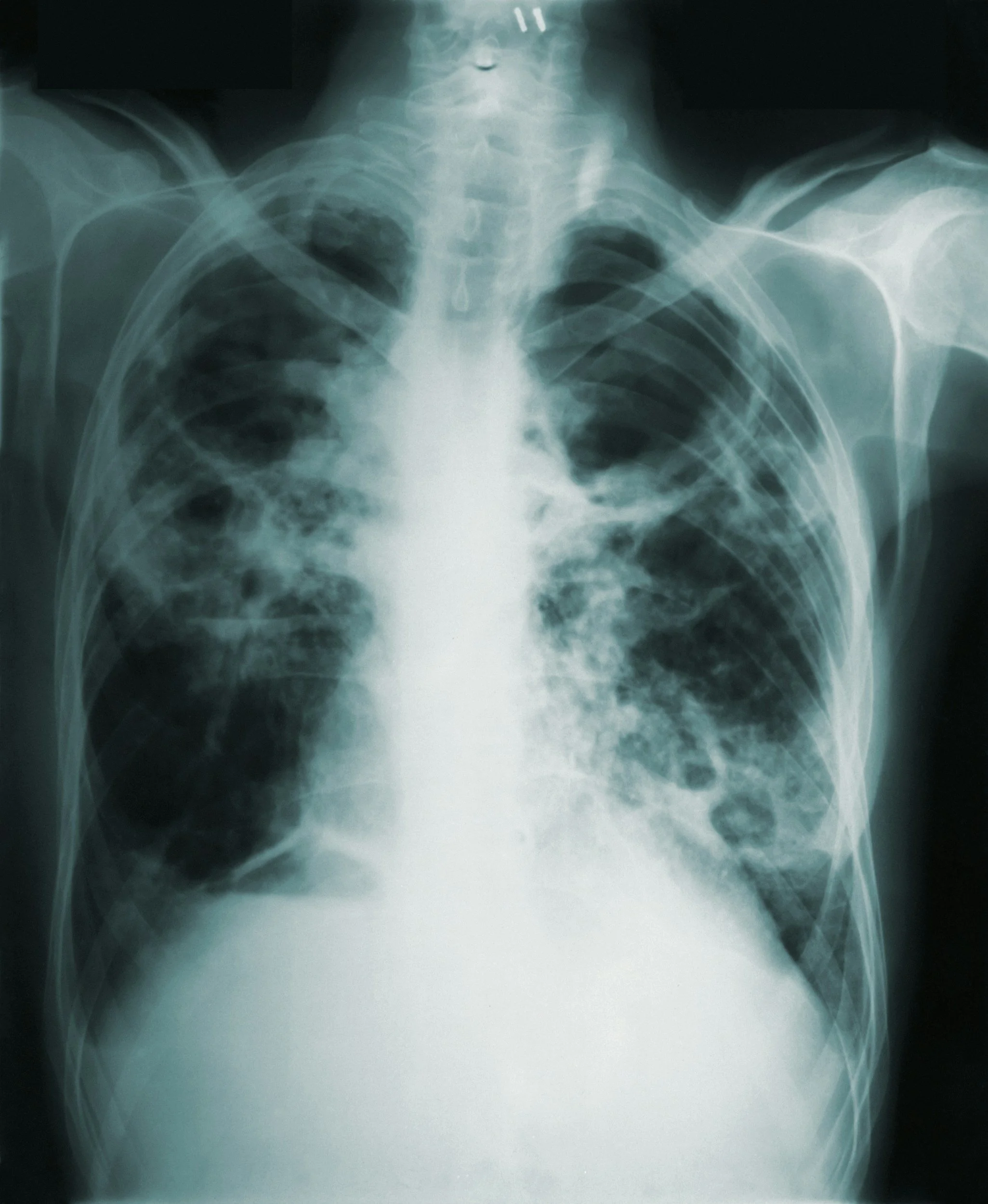 #146 Tuberculosis is Still Here